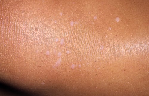 Кальциноз кожи: причины возникновения и методы лечения